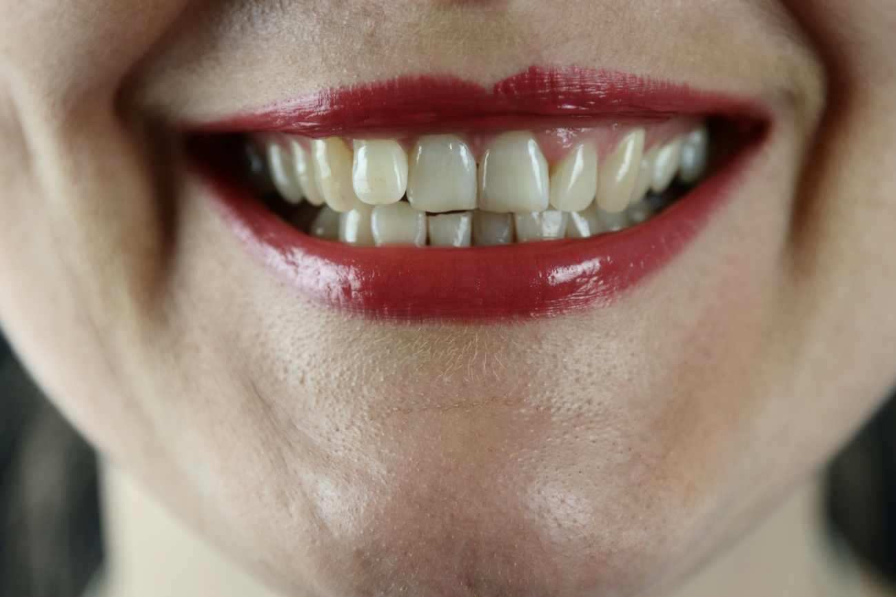 Sorriso perfetto: sono più belli i denti bianchissimi o naturali?